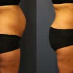 Lipo 2