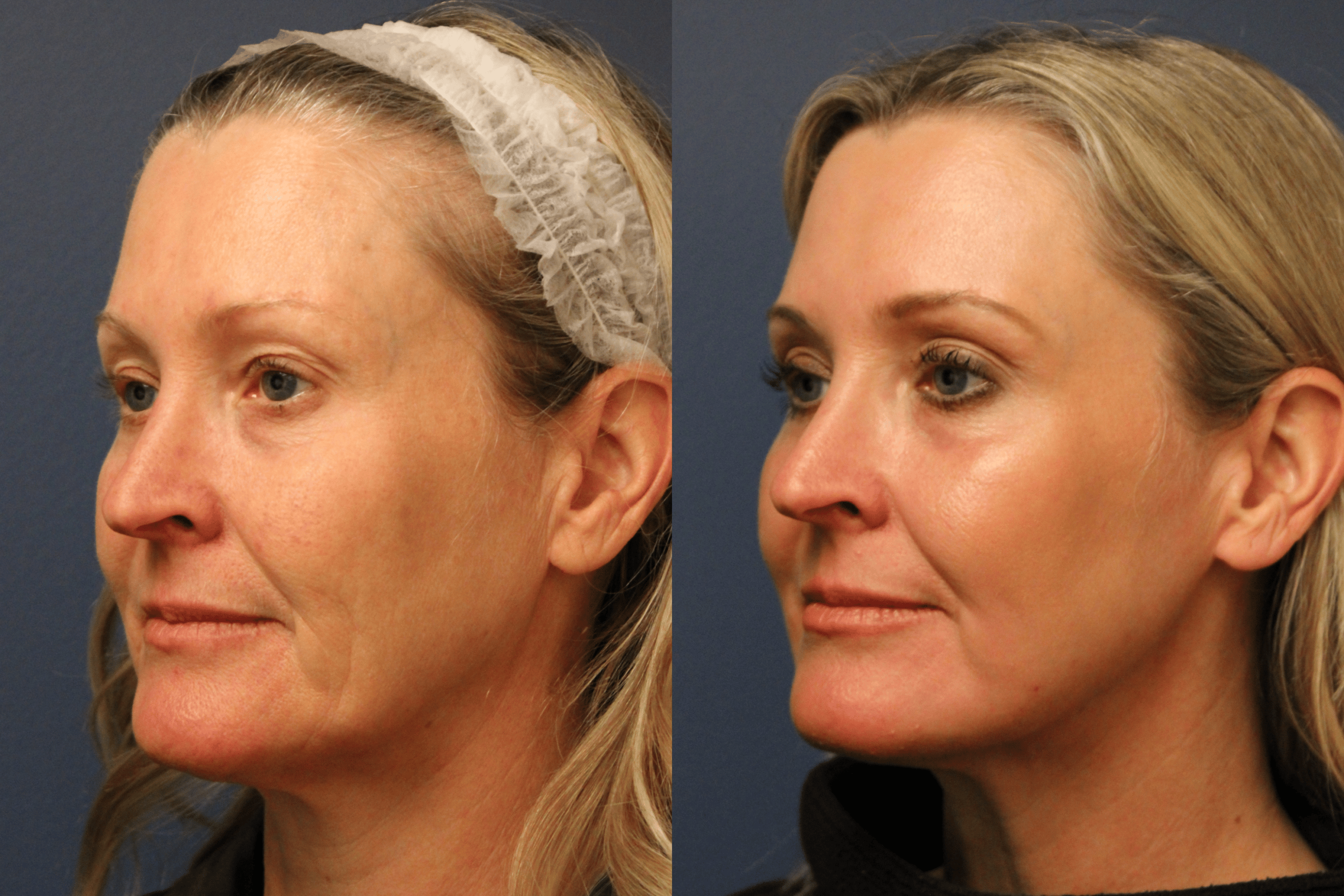 before_after_img