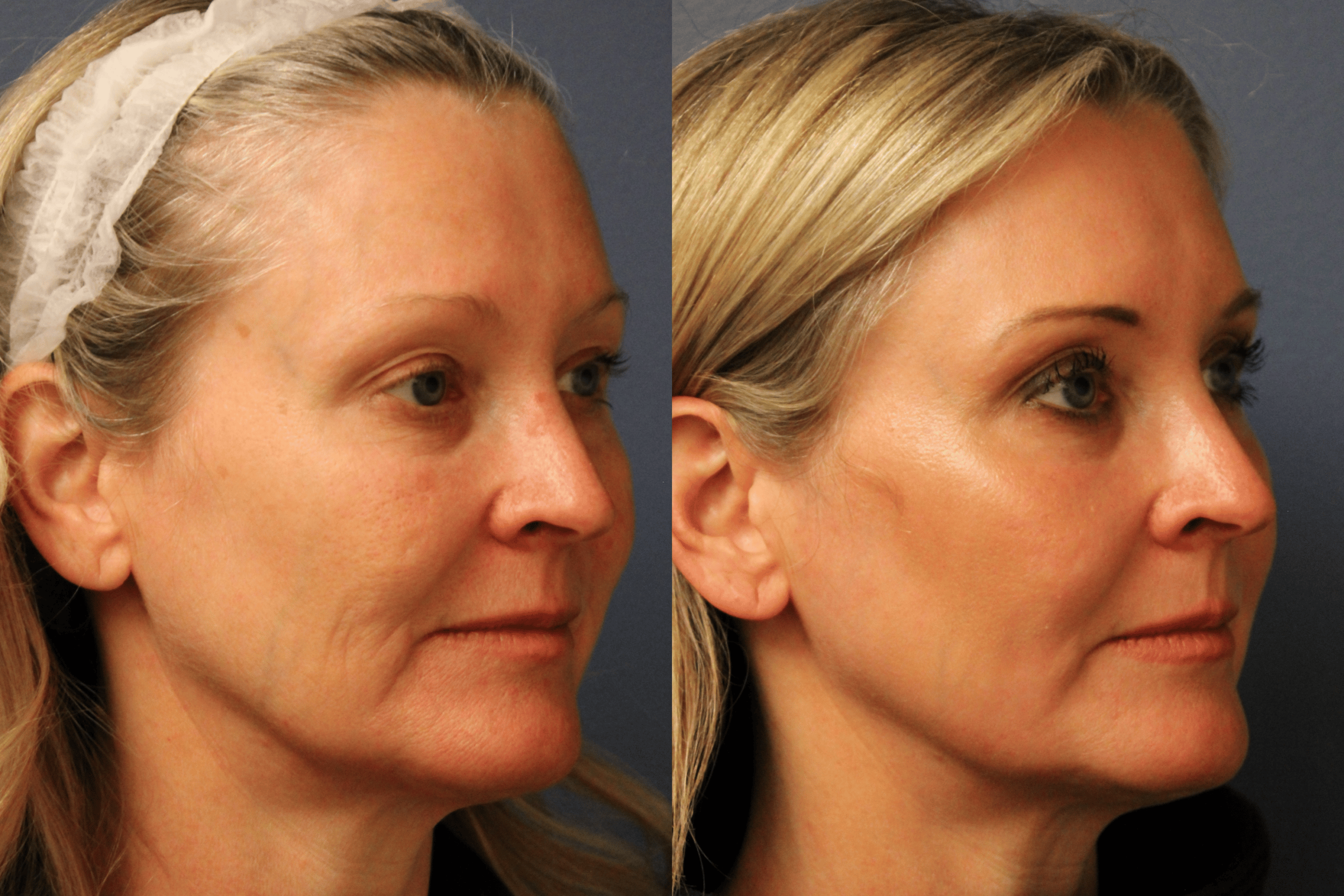before_after_img