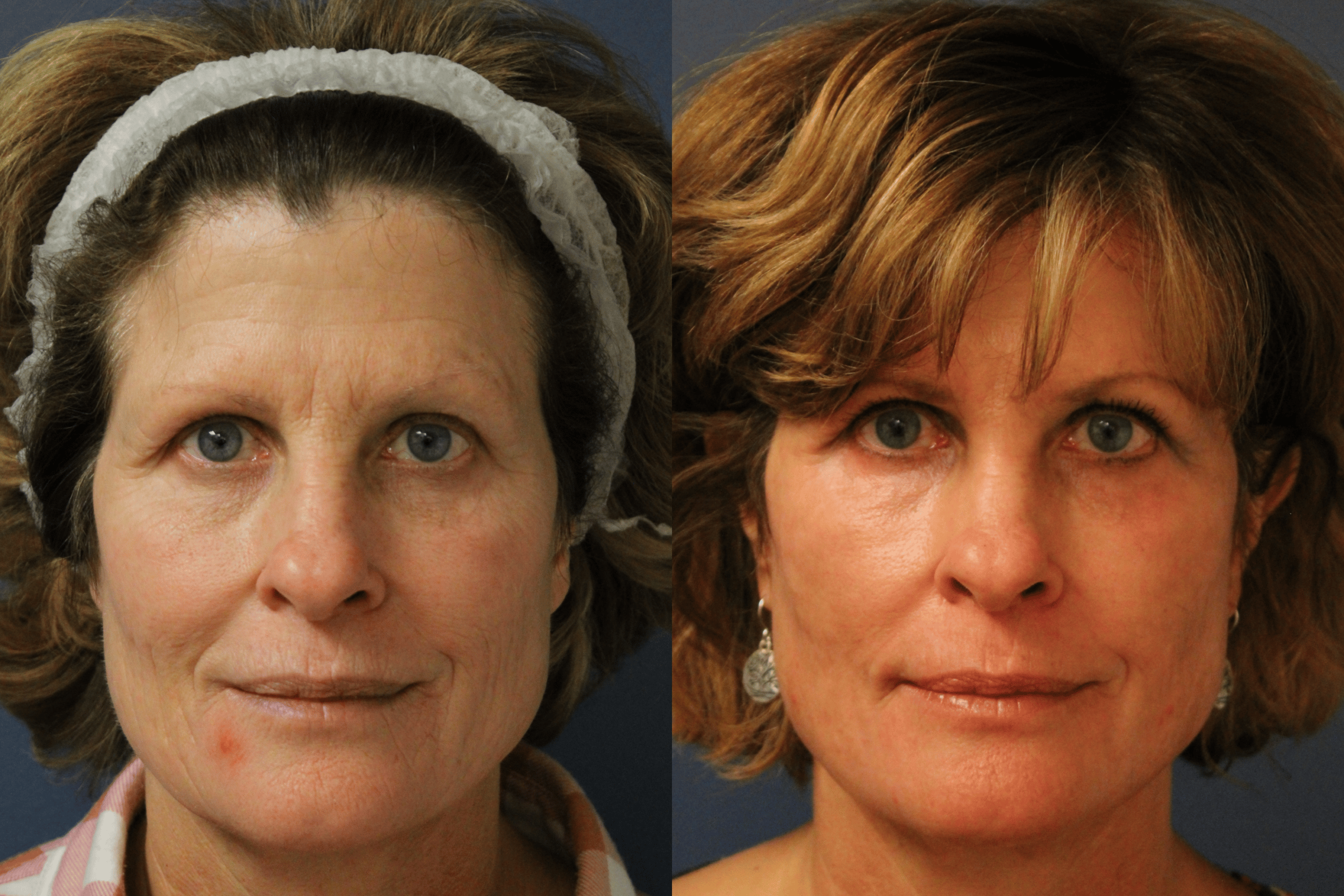 before_after_img