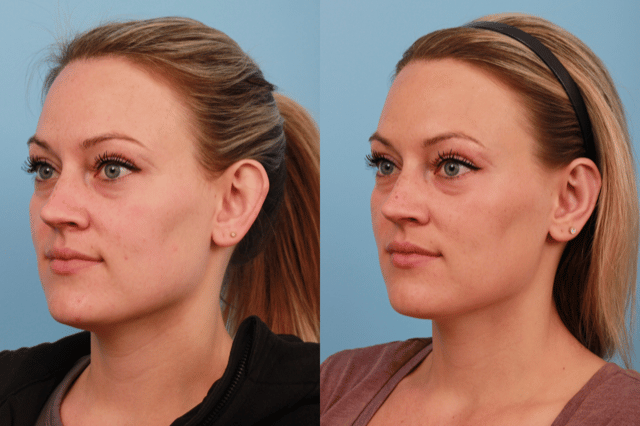 before_after_img