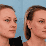 Otoplasty 3