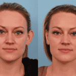 Otoplasty 4