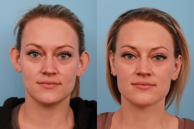 before_after_img