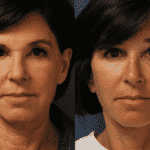 facelift-patient-8a