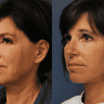 facelift-patient-8c
