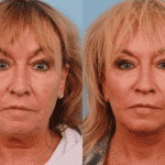 facelift-patient-9a