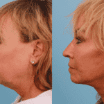 facelift-patient-9c