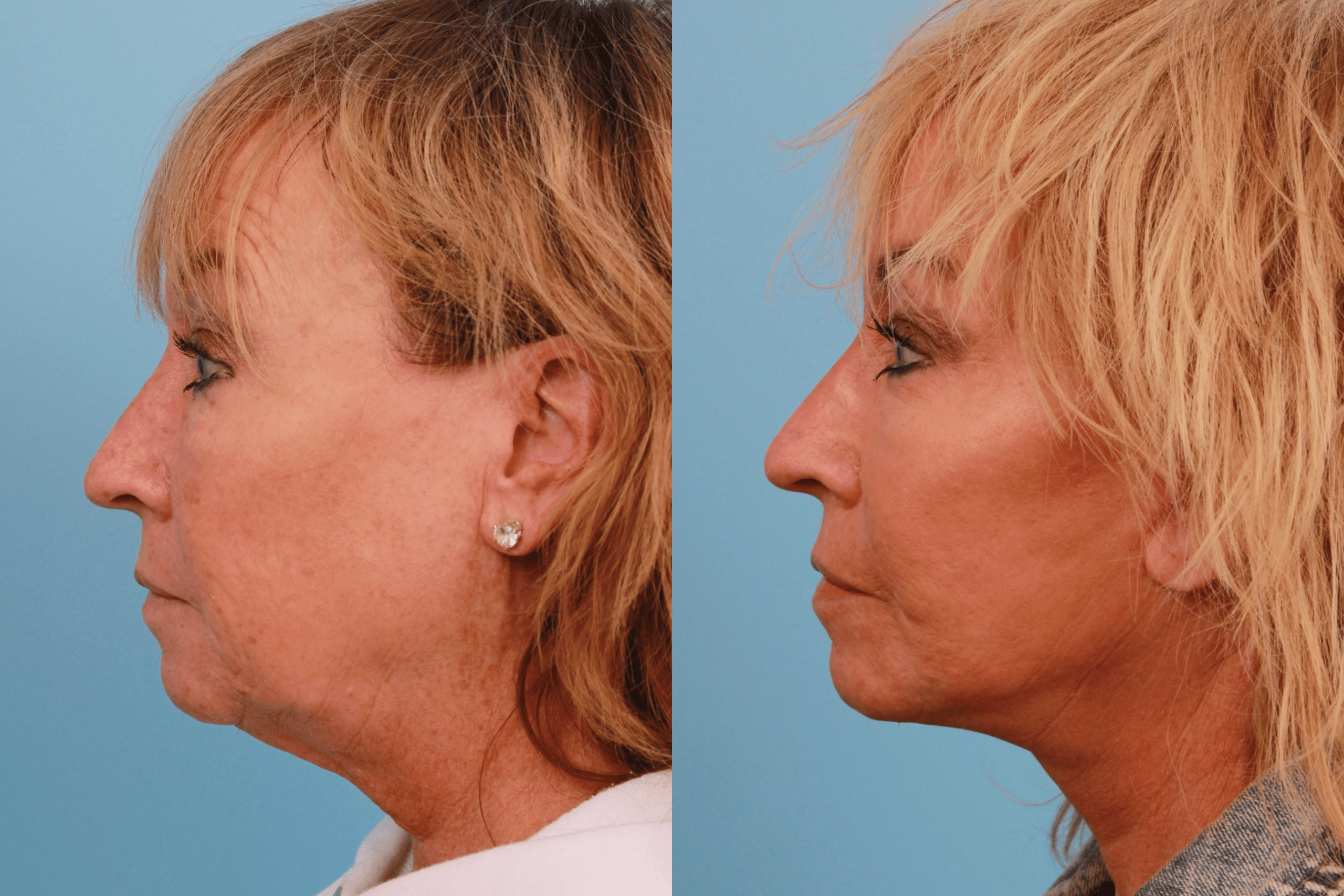 before_after_img