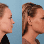 otoplasty 2