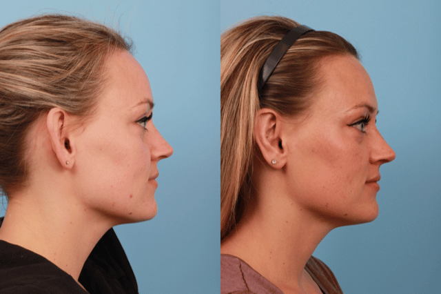 before_after_img