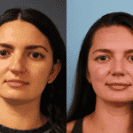 Rhinoplasty Case 1 image A