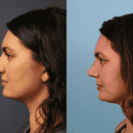 Rhinoplasty Case 1 image B