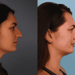 Rhinoplasty Case 1 image C
