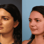 Rhinoplasty Case 1 image E