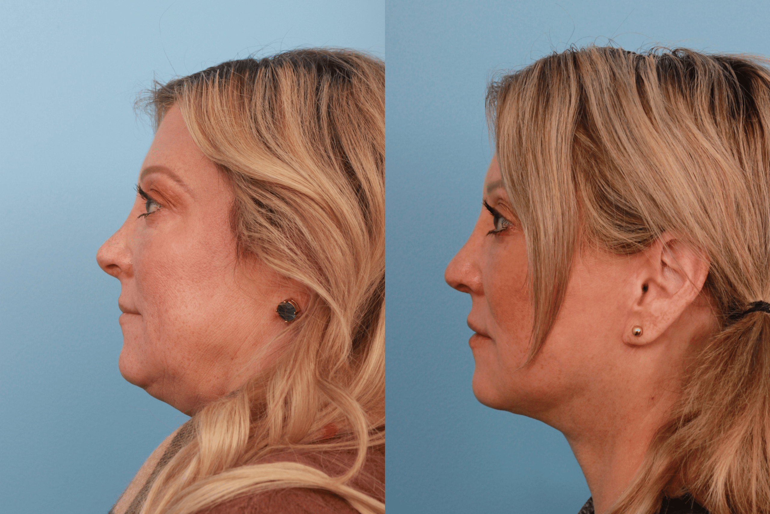 before_after_img