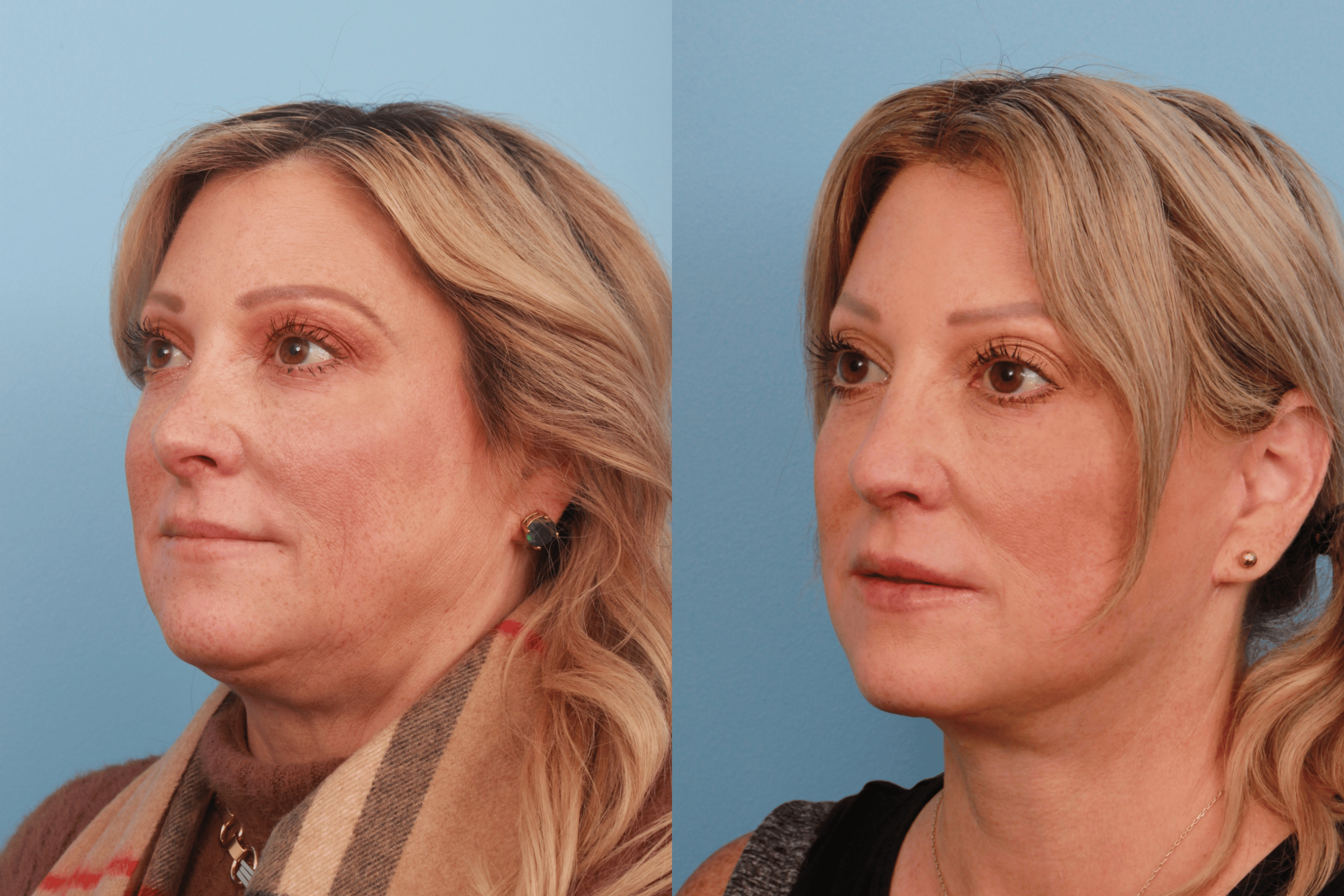 before_after_img