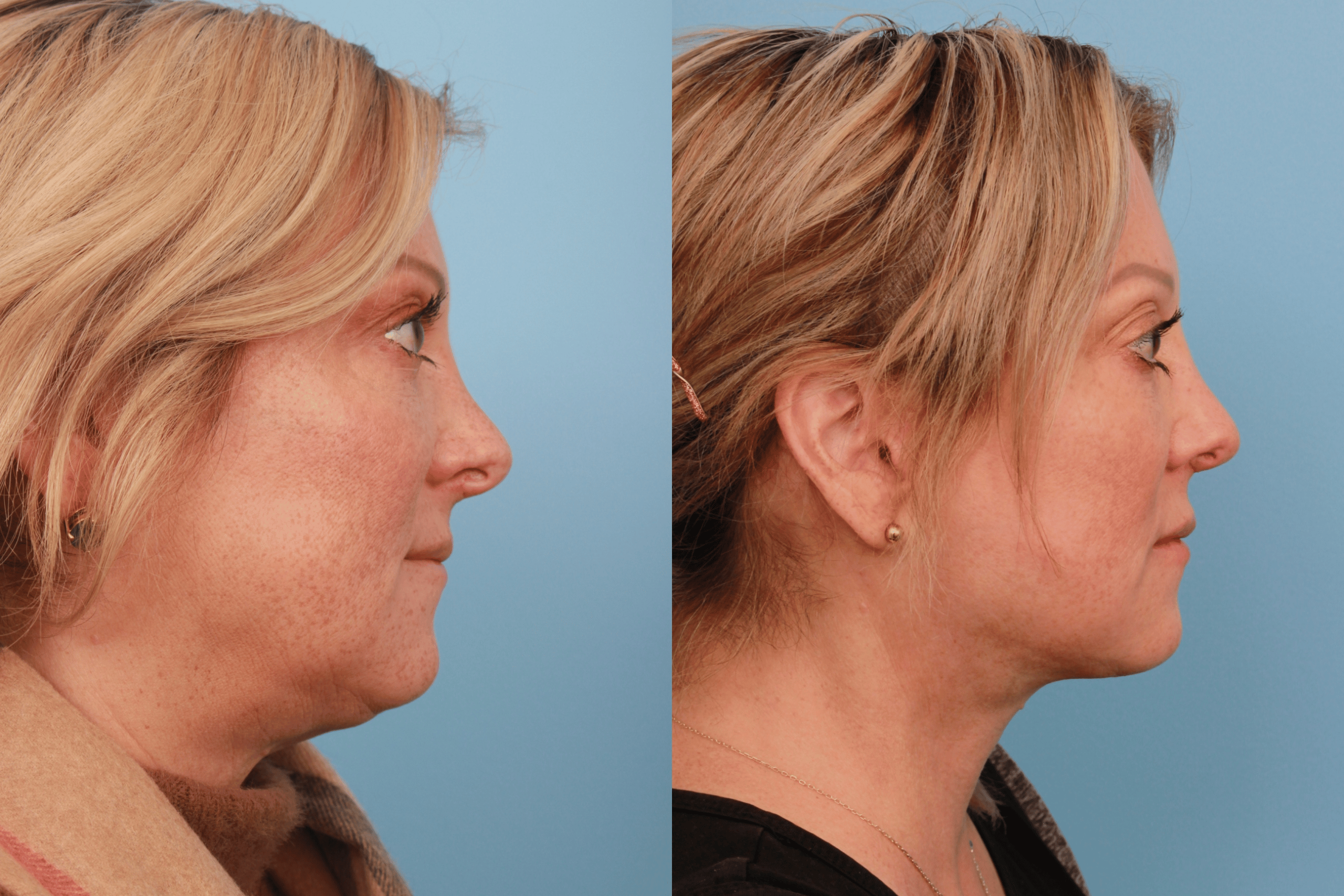 before_after_img