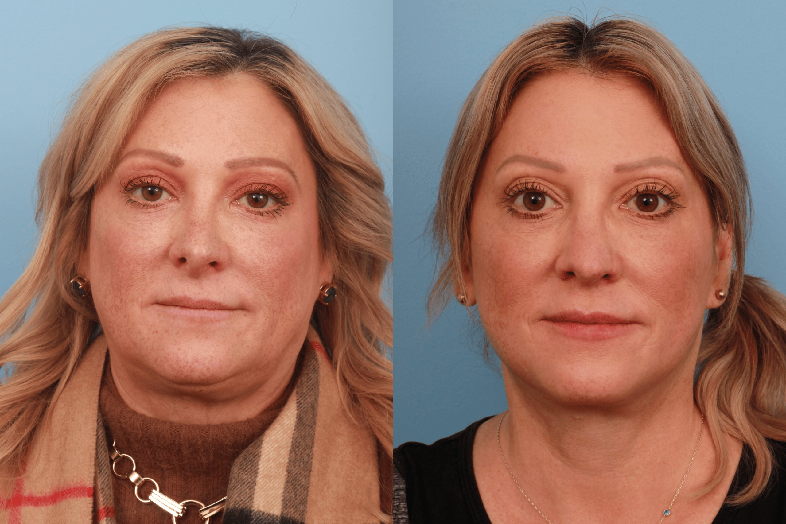 before_after_img