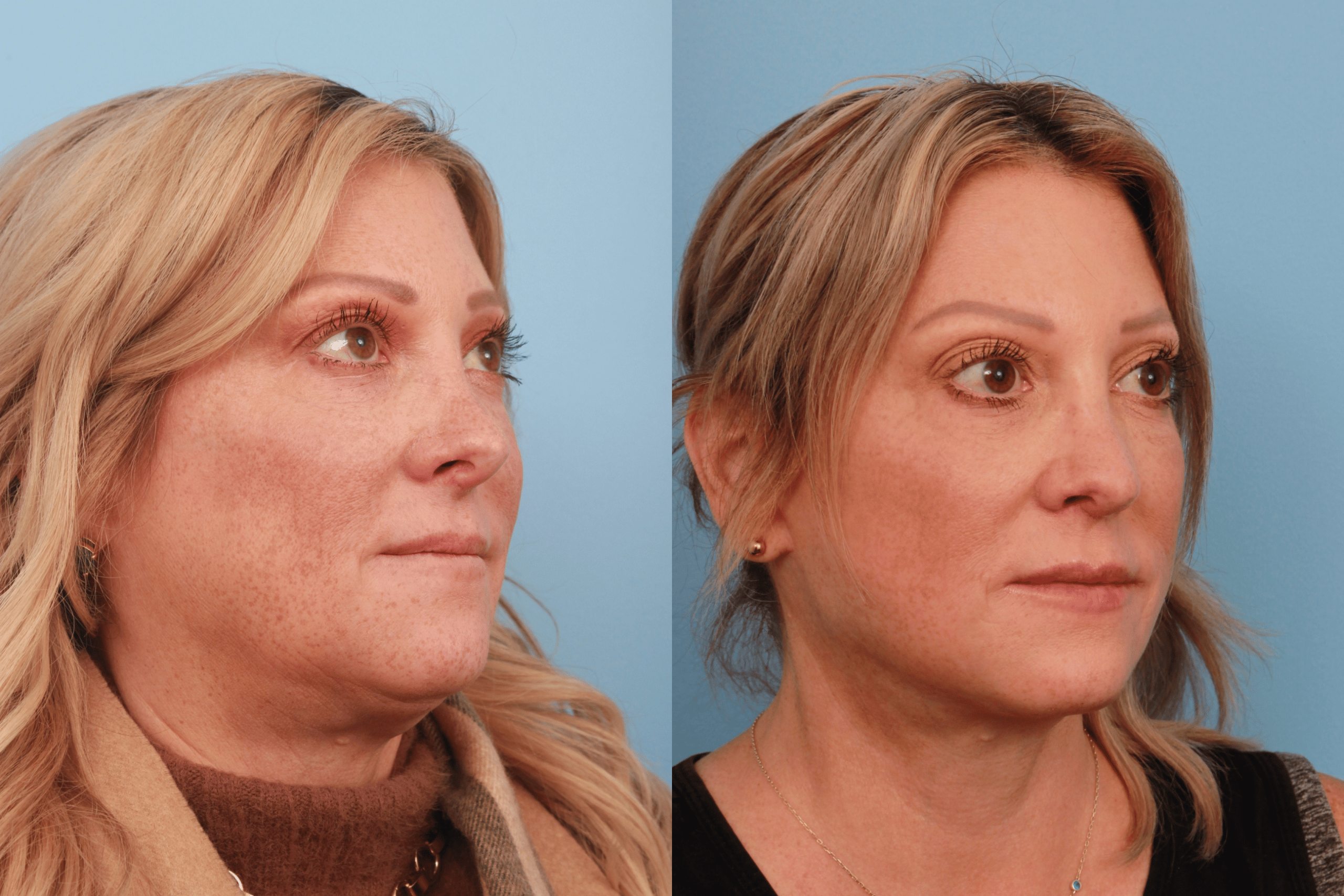 before_after_img