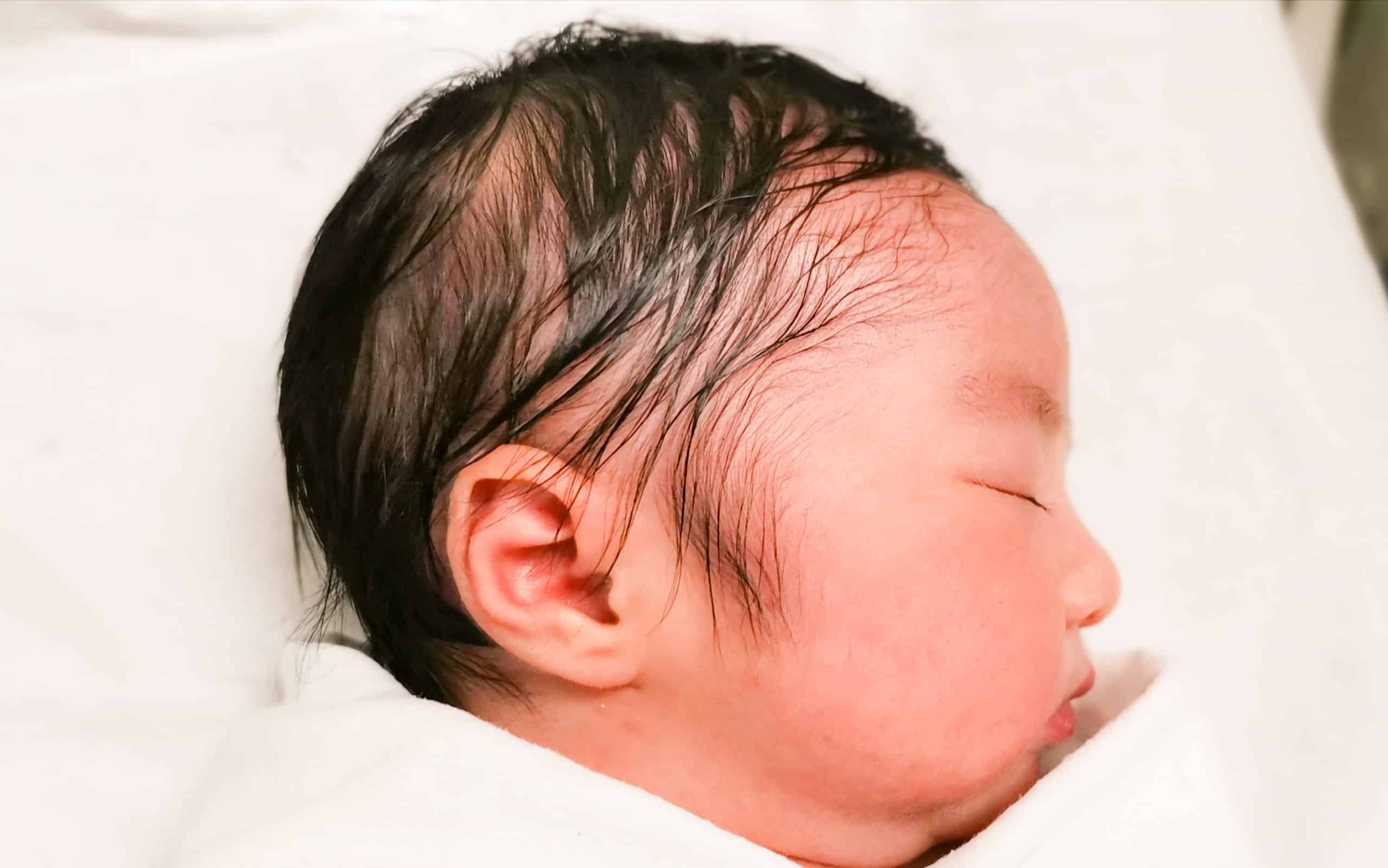 Types Of Baby Ear Deformities And Malformations