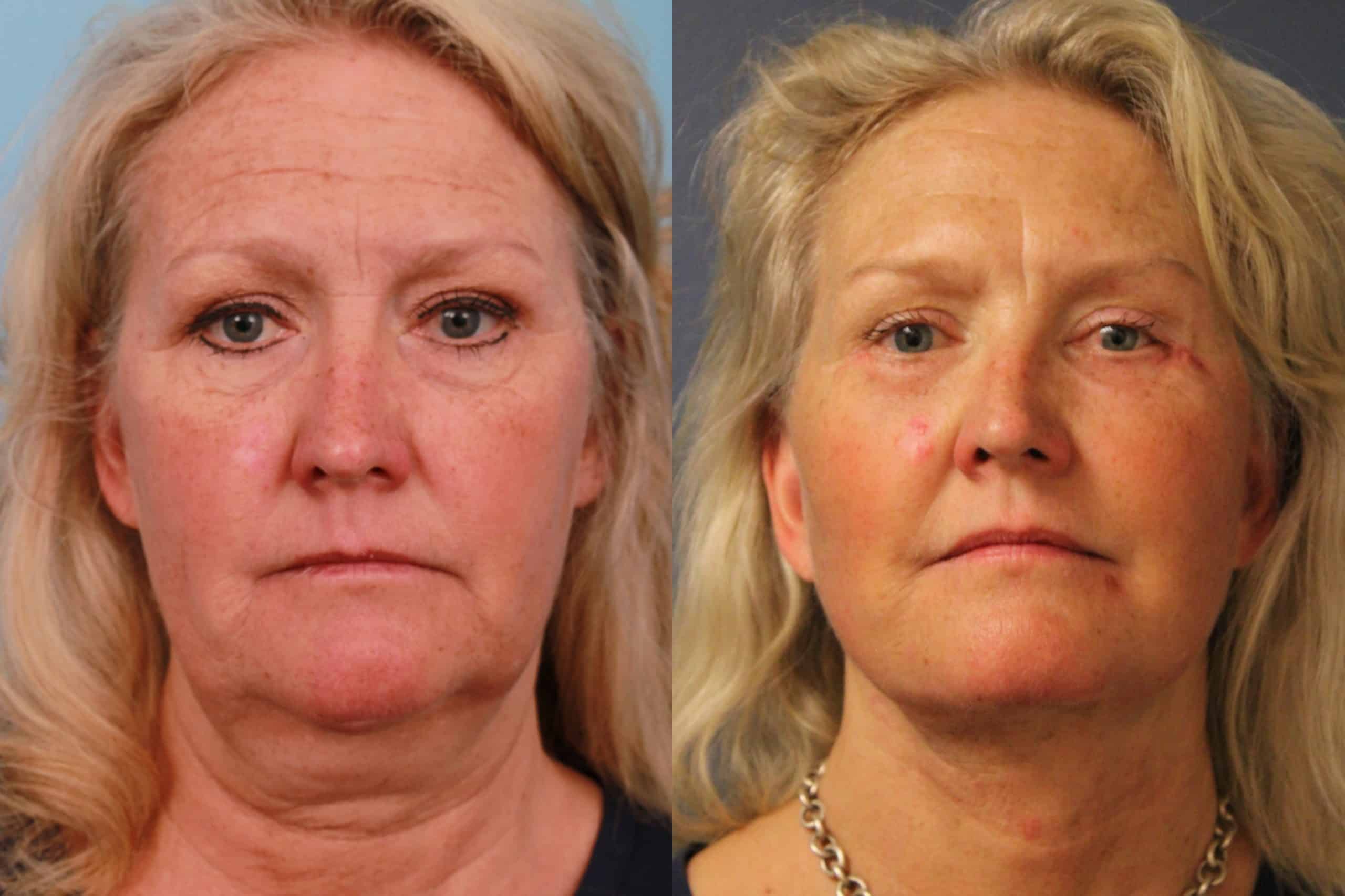 before_after_img