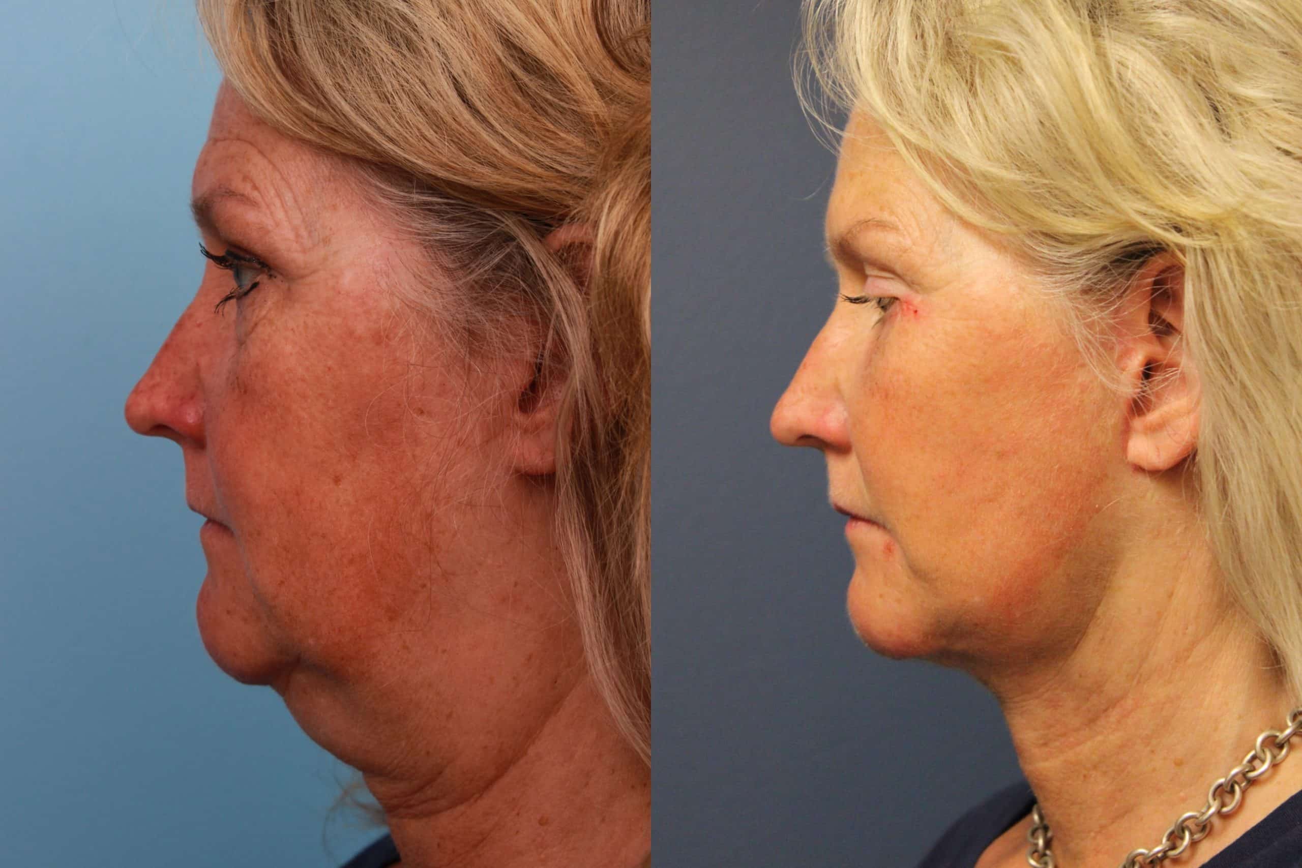 before_after_img