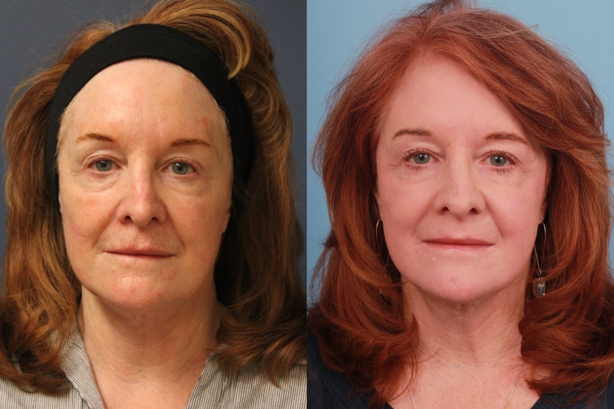 before_after_img