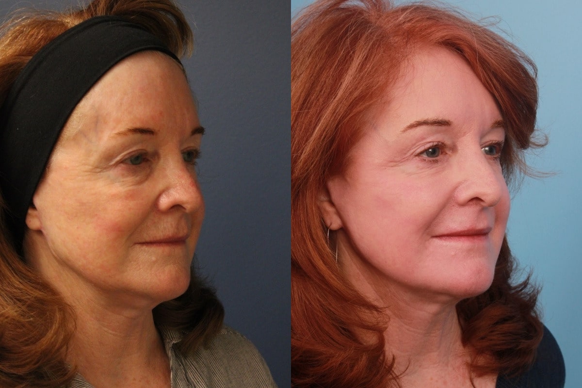 before_after_img