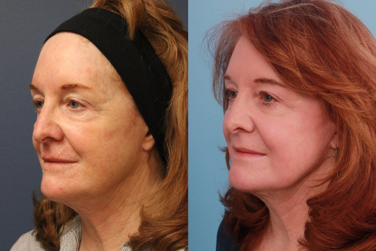 before_after_img