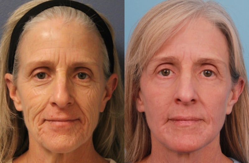 before_after_img