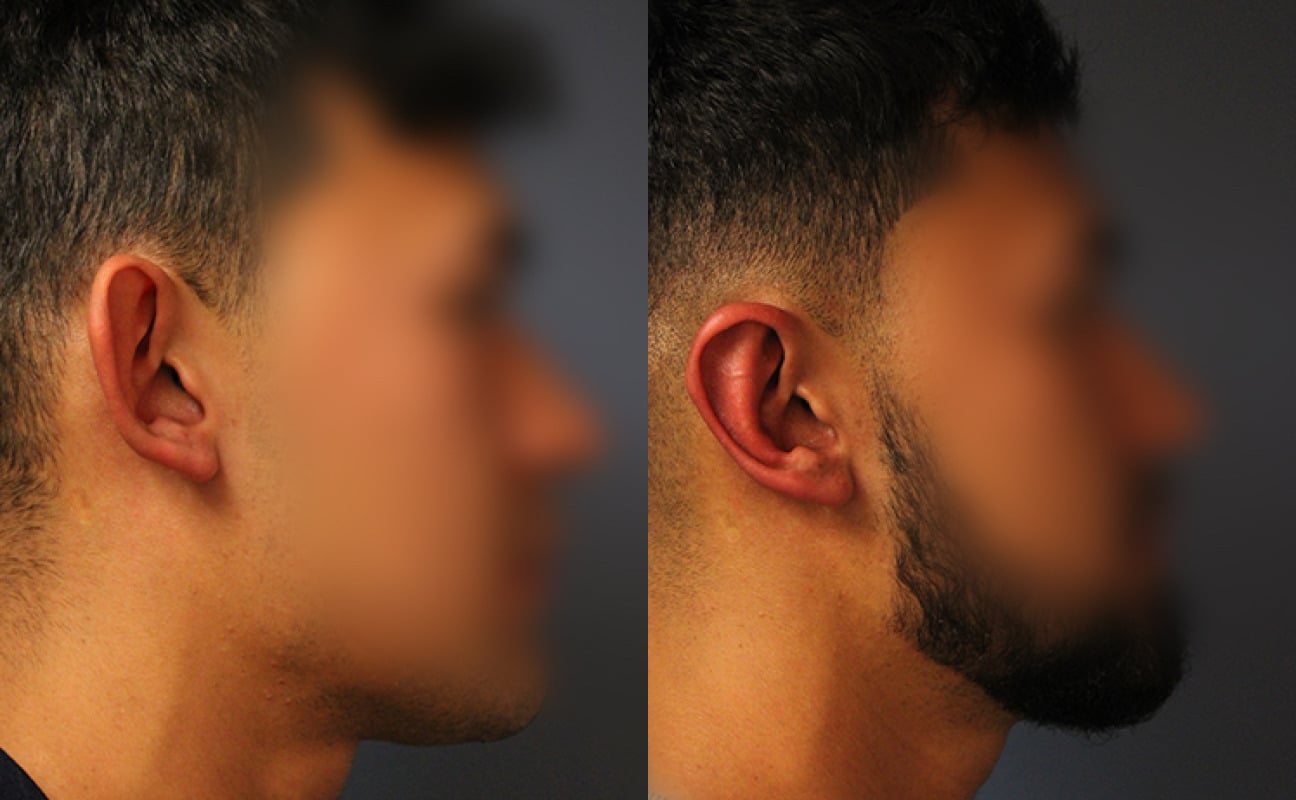 before_after_img