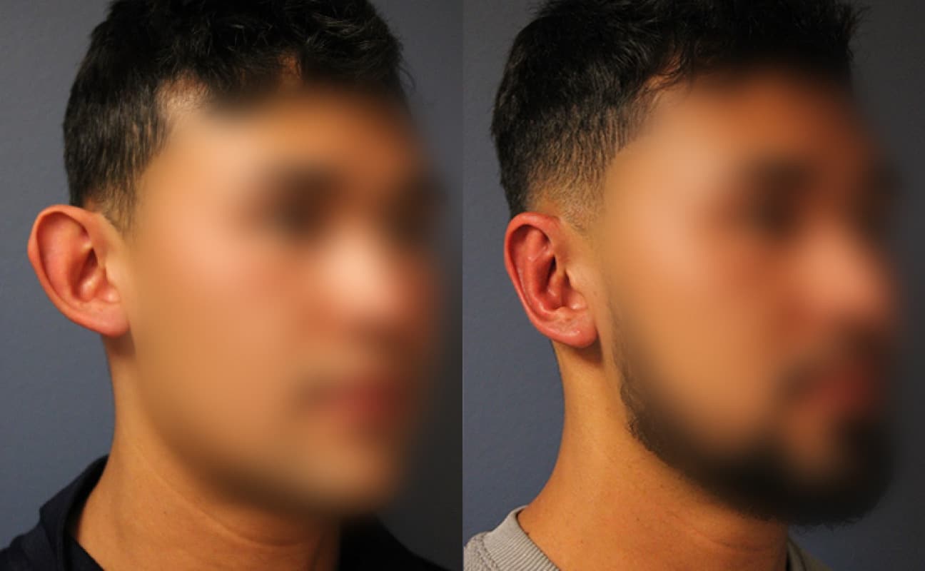 before_after_img