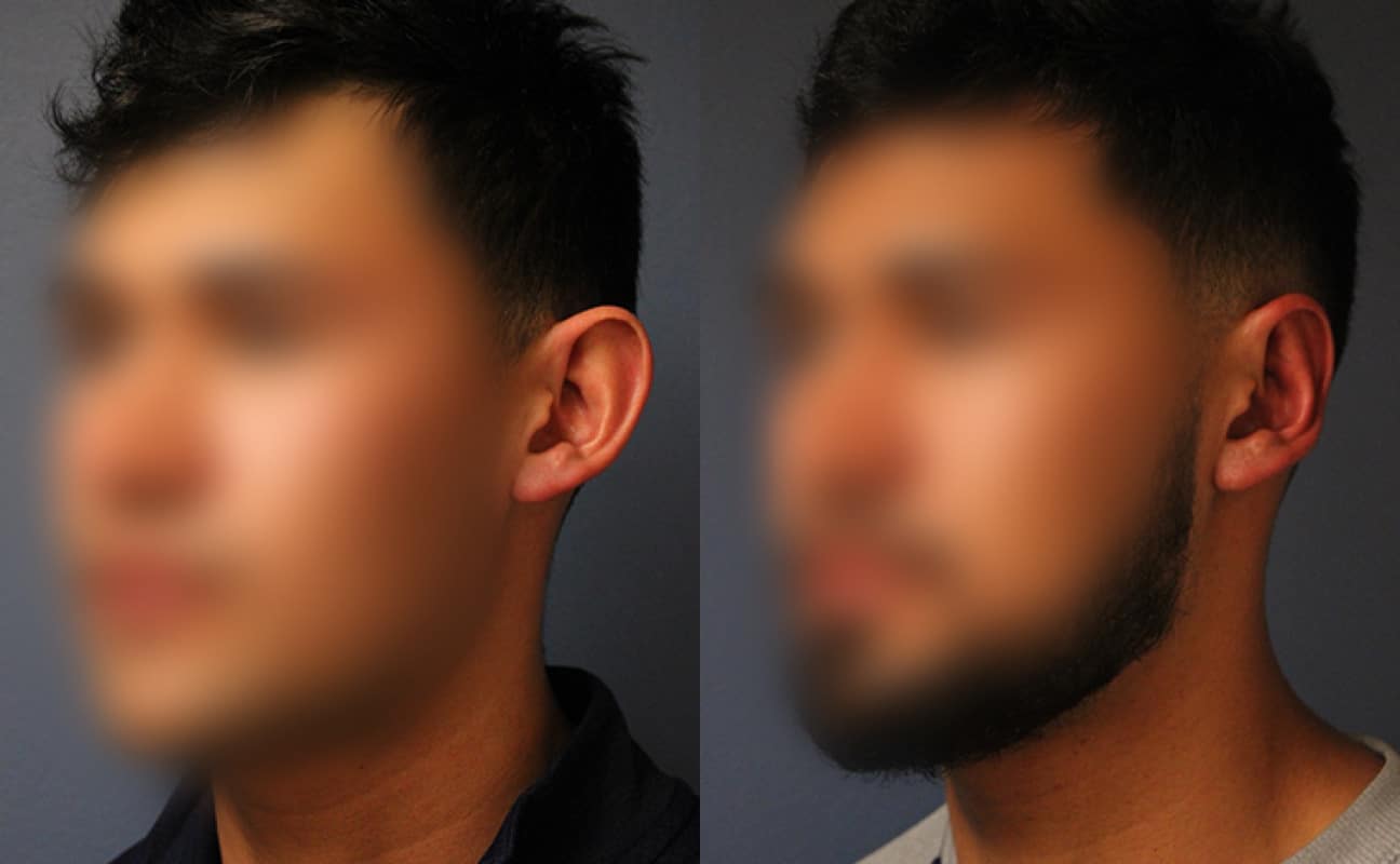 before_after_img