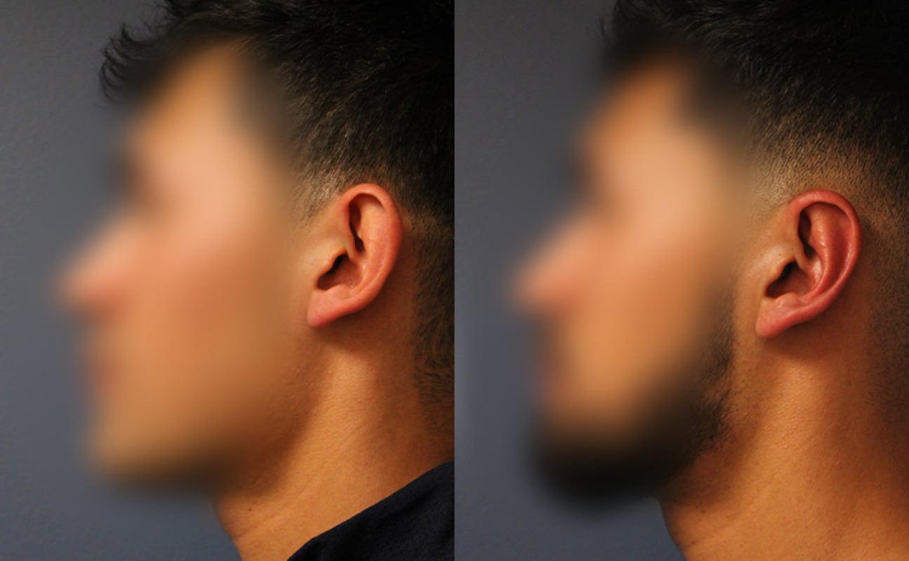 before_after_img
