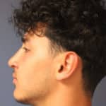 rhinoplasty-after-6
