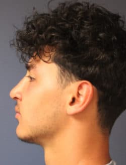 after rhinoplasty