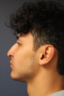 before rhinoplasty