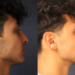 rhinoplasty-merged-5