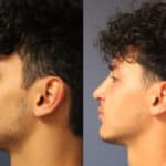 rhinoplasty-merged-6