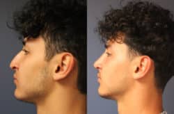 before and after rhinoplasty