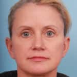 facelift-after