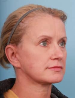 after facelift