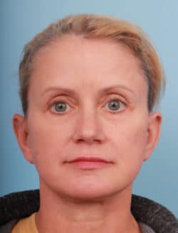after facelift