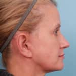facelift-after-3