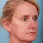 facelift-before-2