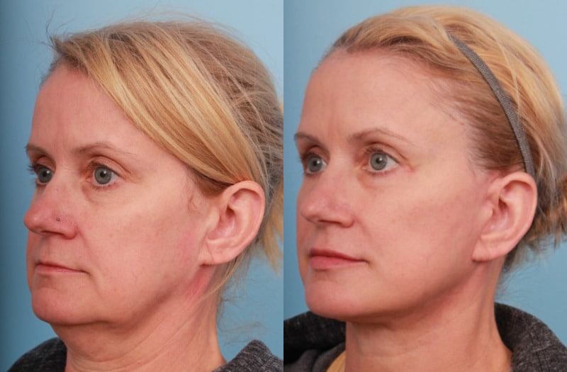 before_after_img