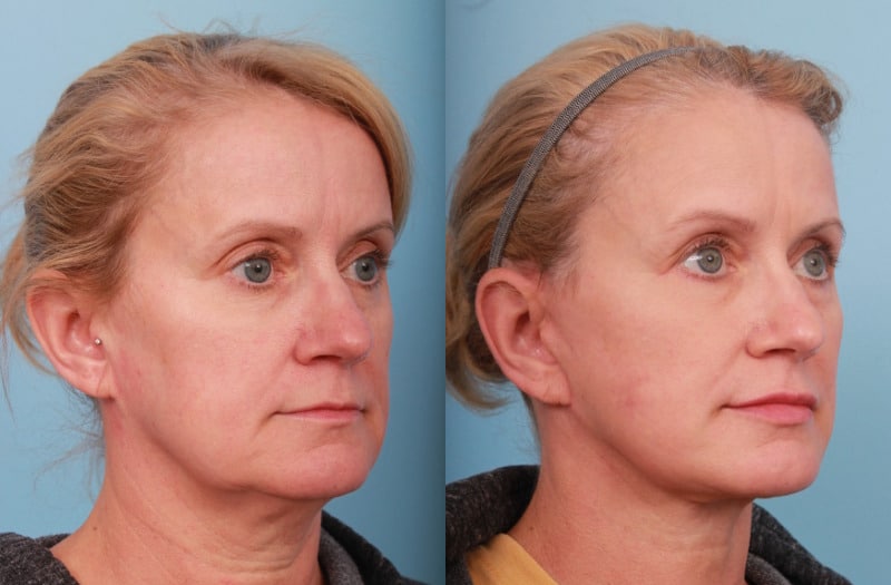 before_after_img