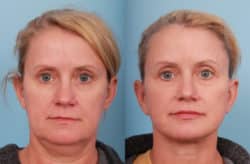 before and after facelift