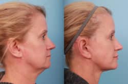 before and after facelift